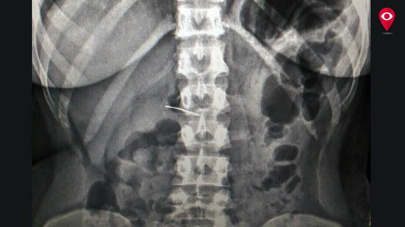 Woman swallows needle while sewing