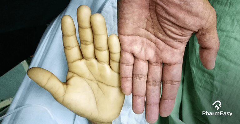 Maharashtra Government to Conduct Screening for Anaemia in 10 Lakh People