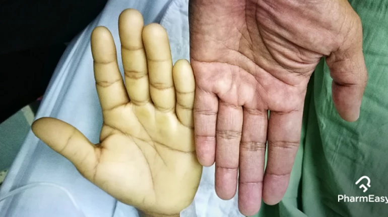 Maharashtra Government to Conduct Screening for Anaemia in 10 Lakh People Maharashtra Government to Conduct Screening for Anaemia in 10 Lakh People