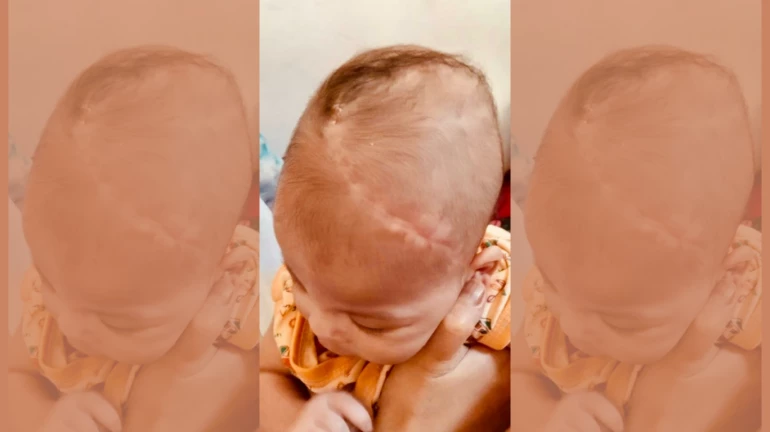 Mumbai: 5 Day-old Baby Operated To Reconstruct 40% Scalp