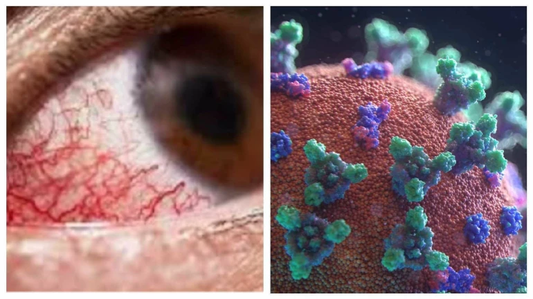 म्युकरमायकोसेसचे सर्वाधिक रुग्ण महाराष्ट्रात म्युकरमायकोसेसचे सर्वाधिक रुग्ण महाराष्ट्रात