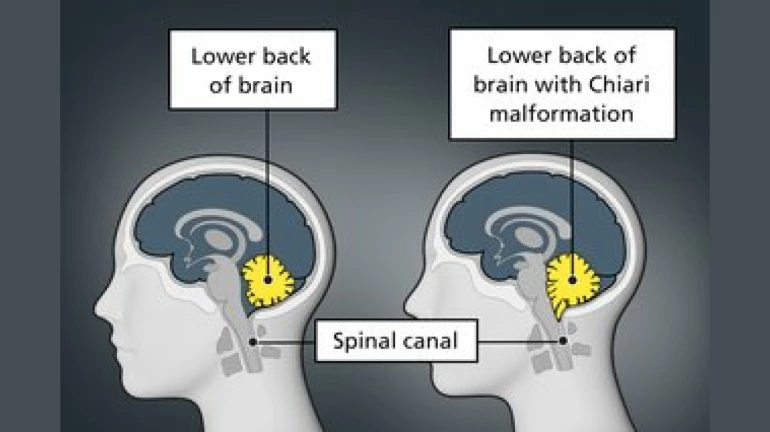 Mumbai hospital successfully treated childhood brain disease of 32-year-old man Mumbai hospital successfully treated childhood brain disease of 32-year-old man
