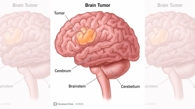 Over 24,000 deaths occur yearly due to Brain Tumour, says Mumbai doctor Over 24,000 deaths occur yearly due to Brain Tumour, says Mumbai doctor