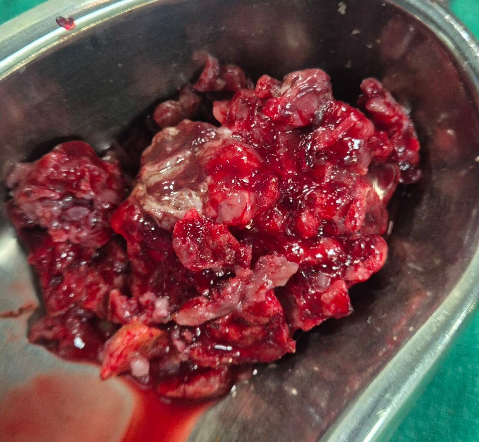 Mumbai Neurosurgeons Remove Large Highly Vascular Brain Tumour Of 50-year-old Patient in Just One Hour