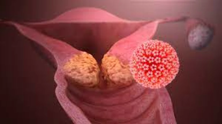 Reducing the Risk of Cervical Cancer: Tips for Maintaining Good Cervical Health