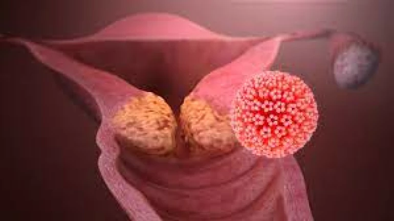 Reducing the Risk of Cervical Cancer: Tips for Maintaining Good Cervical Health Reducing the Risk of Cervical Cancer: Tips for Maintaining Good Cervical Health