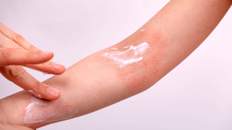 Mumbai: Tuition teacher burns child’s arm with candle Mumbai: Tuition teacher burns child’s arm with candle