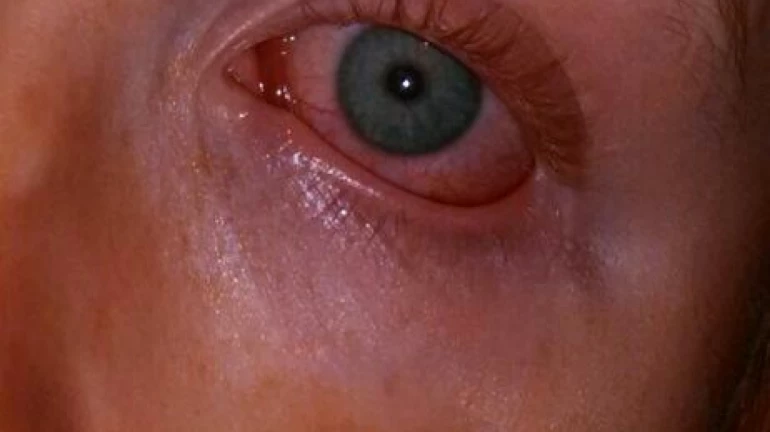 Mumbai Monsoon: Alarming Surge in Conjunctivitis Cases, Children Are Most Affected Mumbai Monsoon: Alarming Surge in Conjunctivitis Cases, Children Are Most Affected