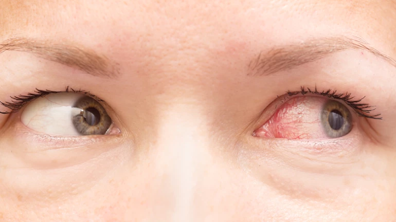 5 दिवसात डोळे येण्याच्या प्रकरणांमध्ये 5 पटीने वाढ 5 दिवसात डोळे येण्याच्या प्रकरणांमध्ये 5 पटीने वाढ