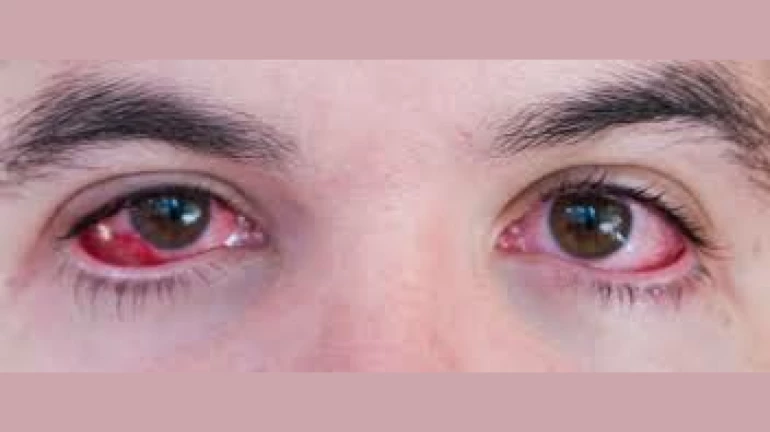 Why There Is Sudden Surge In Conjunctivitis Cases In Mumbai? Why There Is Sudden Surge In Conjunctivitis Cases In Mumbai?