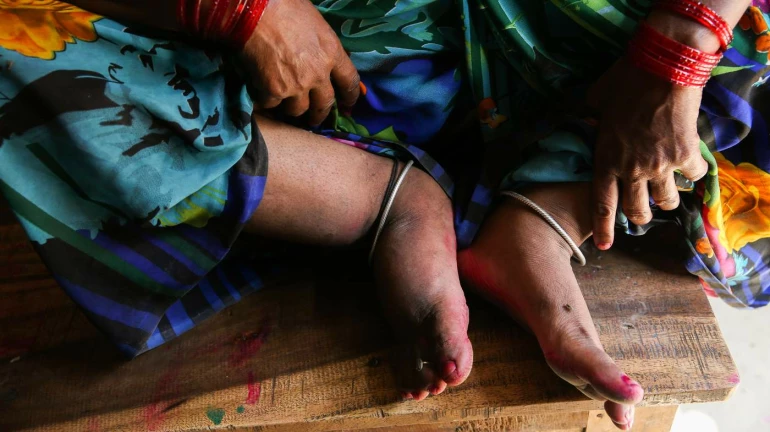 पनवेल में के एलिफैंटियासिस (हाथी पैर) 52 मरीज सामने आए पनवेल में के एलिफैंटियासिस (हाथी पैर) 52 मरीज सामने आए