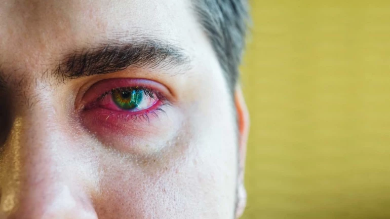 Maharashtra: The epidemic of eyesore cases is now under control Maharashtra: The epidemic of eyesore cases is now under control