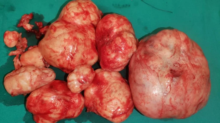 Multiple fibroids weighing 2.25 kgs removed to preserve uterus for pregnancy of 39-year-old Multiple fibroids weighing 2.25 kgs removed to preserve uterus for pregnancy of 39-year-old