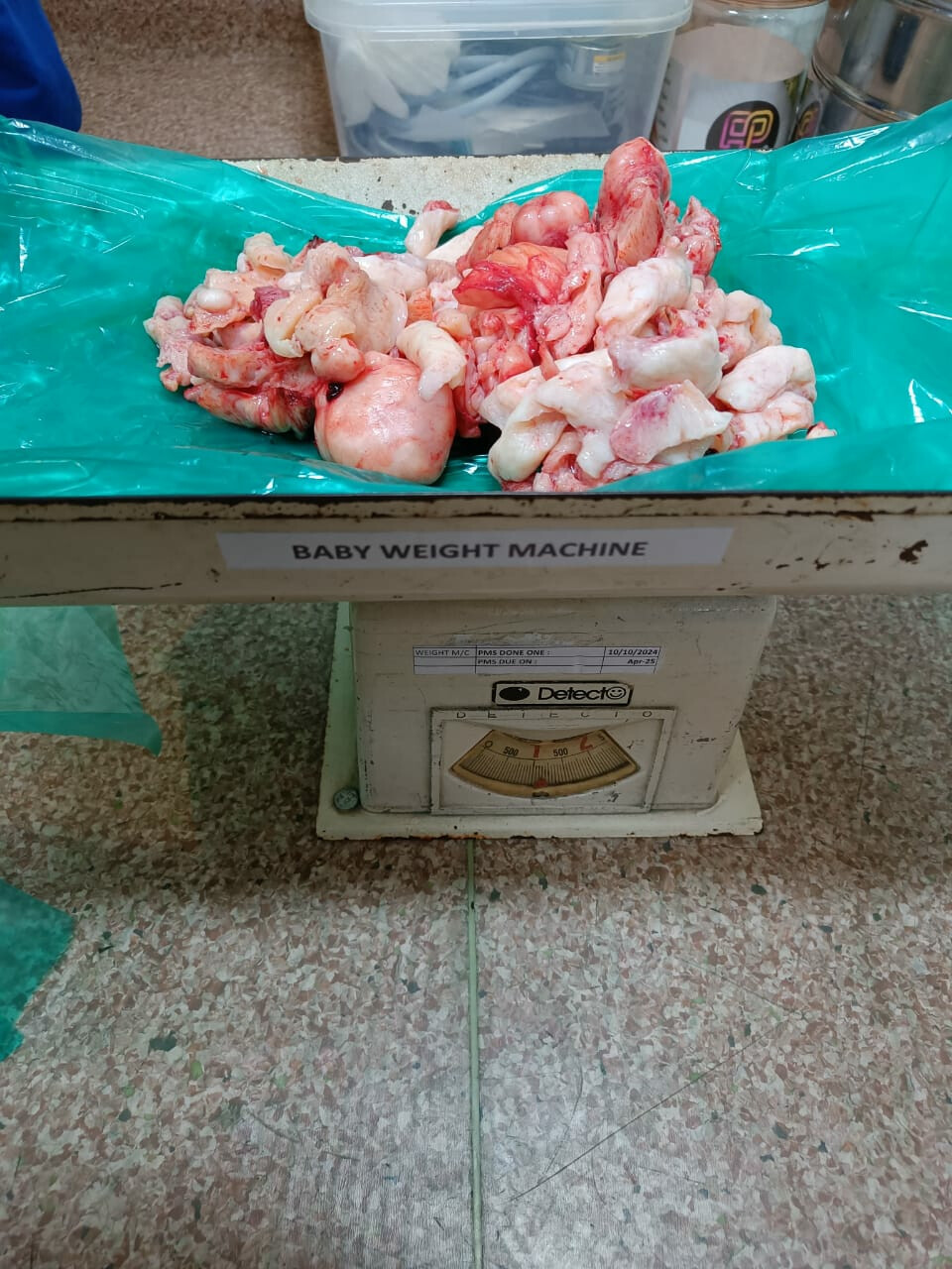 Mumbai Doctors Successfully Removes 1.25 kg Fibroid Uterus via Minimally Invasive