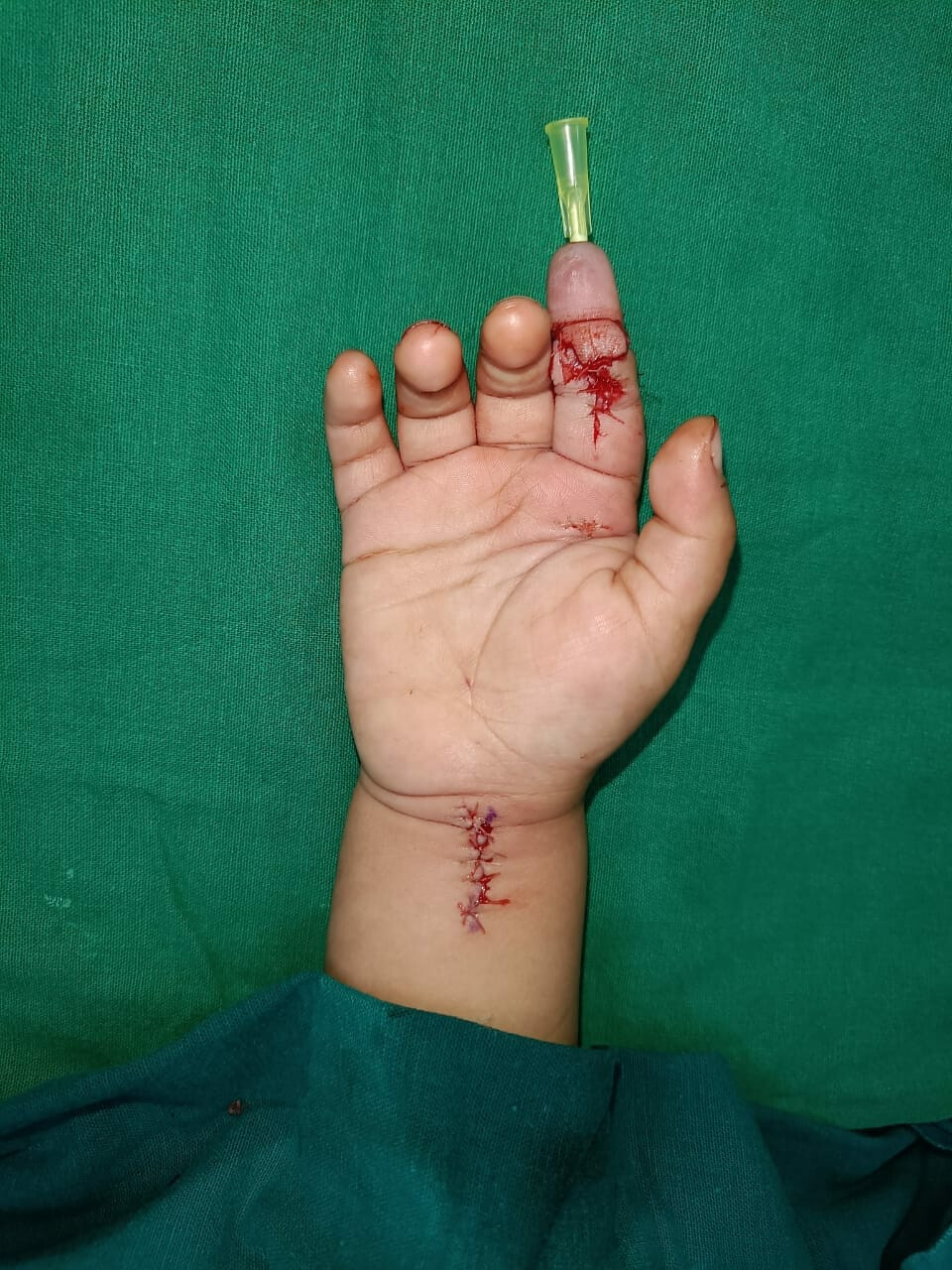 Mumbai Doctors Re-join Severed Index Finger of 20-Month-Old Child