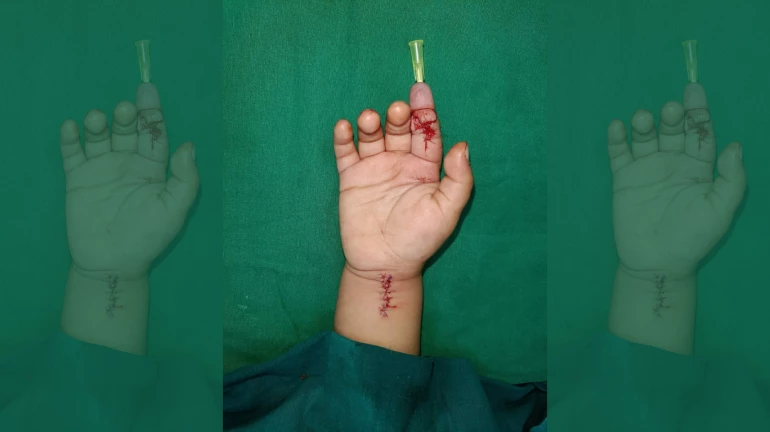 Mumbai Doctors Re-join Severed Index Finger of 20-Month-Old Child