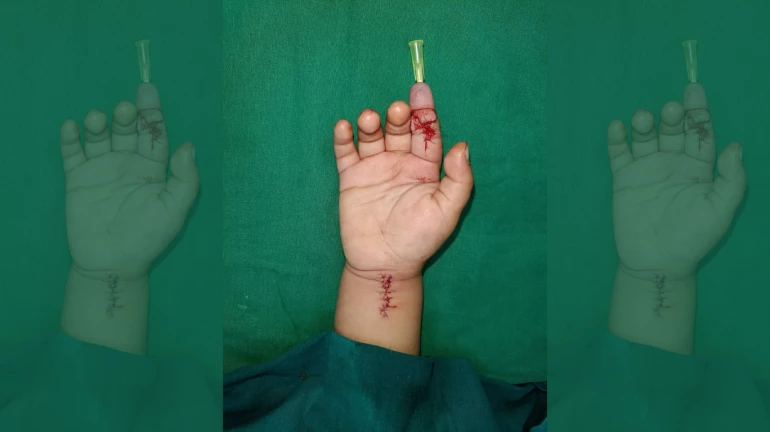 Mumbai Doctors Re-join Severed Index Finger of 20-Month-Old Child Mumbai Doctors Re-join Severed Index Finger of 20-Month-Old Child