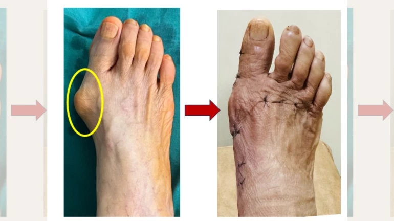 Mumbai Suburbs Get Advanced Minimally Invasive Bunion Surgery At Borivali Hospital Mumbai Suburbs Get Advanced Minimally Invasive Bunion Surgery At Borivali Hospital