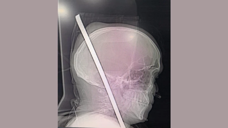 सीने में घुसा लोहे का रोड सिर से निकला बाहर, डॉक्टरों ने बचाई जान सीने में घुसा लोहे का रोड सिर से निकला बाहर, डॉक्टरों ने बचाई जान