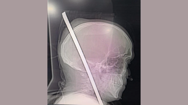 छातीत घुसलेली सळी डोक्यातून बाहेर पडली, मजुराला वाचवण्यात झेन रुग्णालयाला यश छातीत घुसलेली सळी डोक्यातून बाहेर पडली, मजुराला वाचवण्यात झेन रुग्णालयाला यश