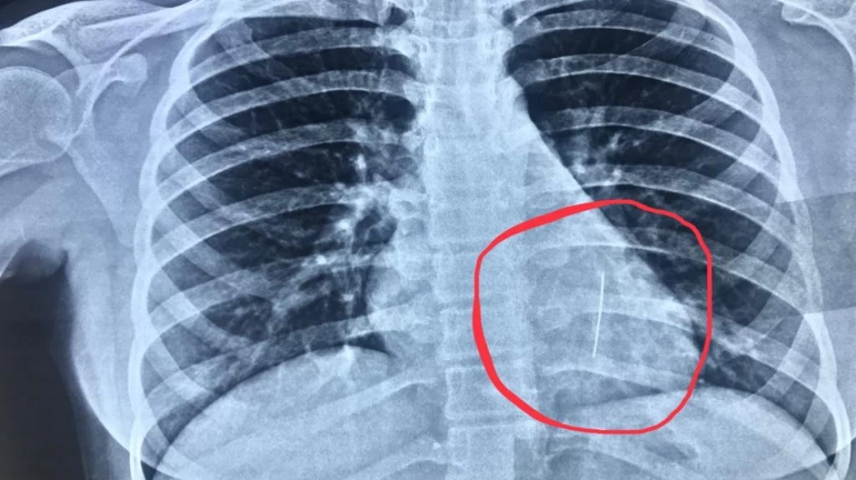 सीने में फंसी धारदार पिन को निकालने में सफल हुए जैन हॉस्पिटल के डॉक्टर सीने में फंसी धारदार पिन को निकालने में सफल हुए जैन हॉस्पिटल के डॉक्टर