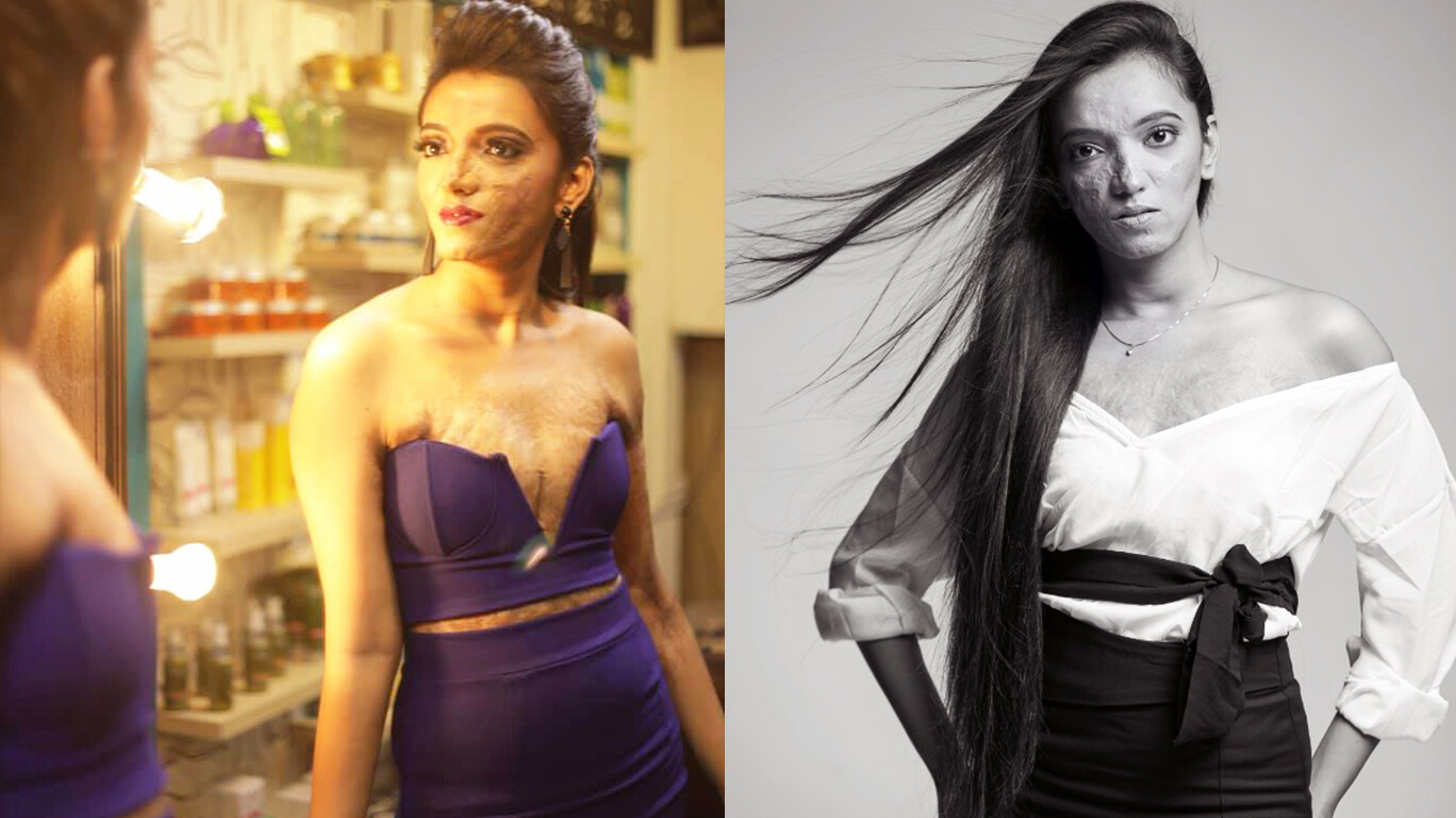 अंतरराष्ट्रीय महिला दिवस-  चेहरा जल गया , लेकिन सपनें नहीं ...!