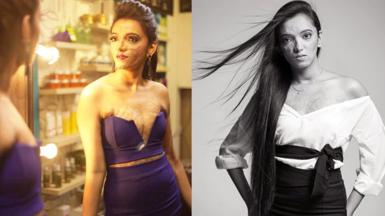 अंतरराष्ट्रीय महिला दिवस-  चेहरा जल गया , लेकिन सपनें नहीं ...! अंतरराष्ट्रीय महिला दिवस-  चेहरा जल गया , लेकिन सपनें नहीं ...!