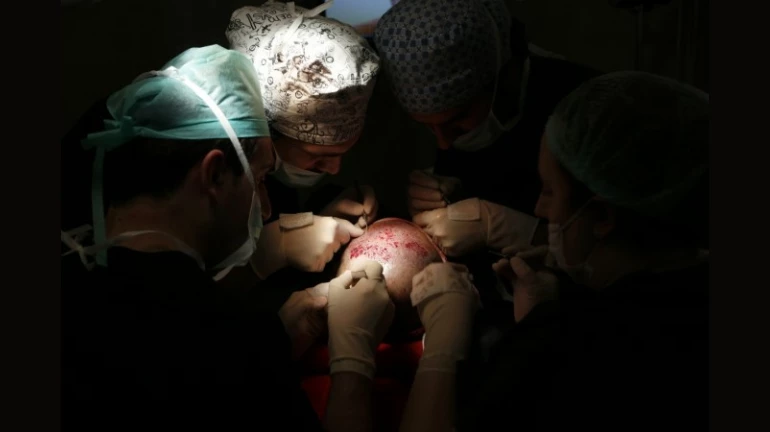 Debunking the myths of hair transplant Debunking the myths of hair transplant