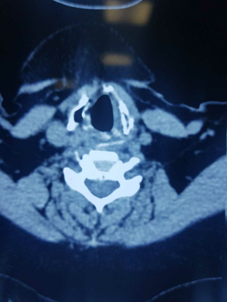 55 वर्षीय महिला के गले में अटकी मुर्गे की हड्डी निकाली गई