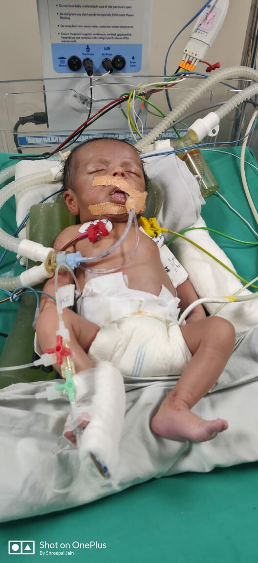 ८ दिवसाच्या बाळाची मृत्यूशी यशस्वी झुंज