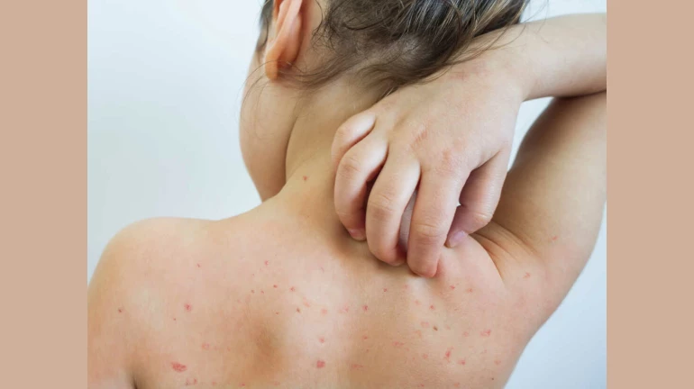 मुंबई में अब खसरे का डर, गोवंडी में तीन बच्चो की मौत मुंबई में अब खसरे का डर, गोवंडी में तीन बच्चो की मौत