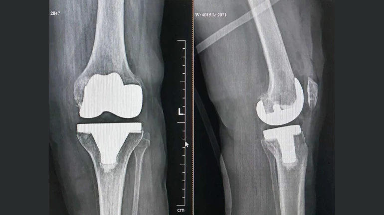 78 –Year-Old Mumbai Woman with 'Neglected club foot' can now walk, stand on her feet 78 –Year-Old Mumbai Woman with 'Neglected club foot' can now walk, stand on her feet