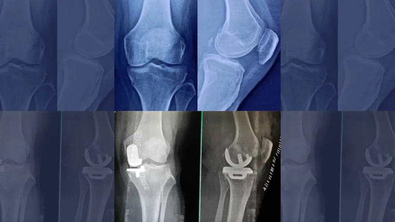 Partial Knee Replacement surgery is more popular in Mumbai