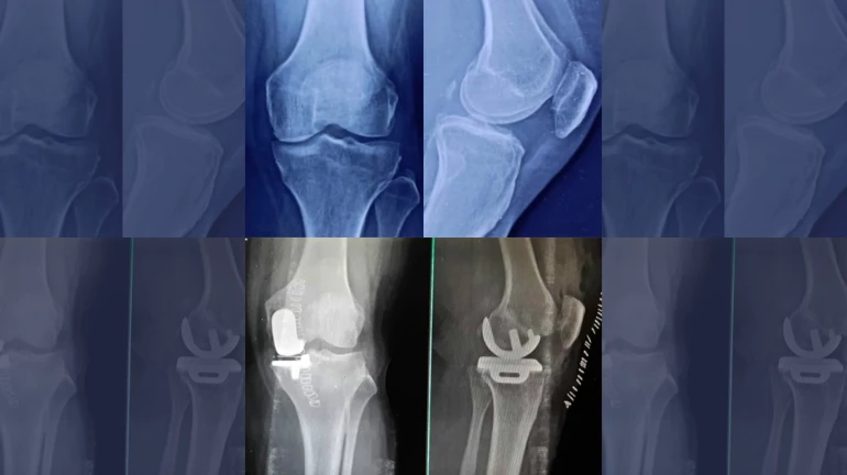 Partial Knee Replacement surgery is more popular in Mumbai Partial Knee Replacement surgery is more popular in Mumbai