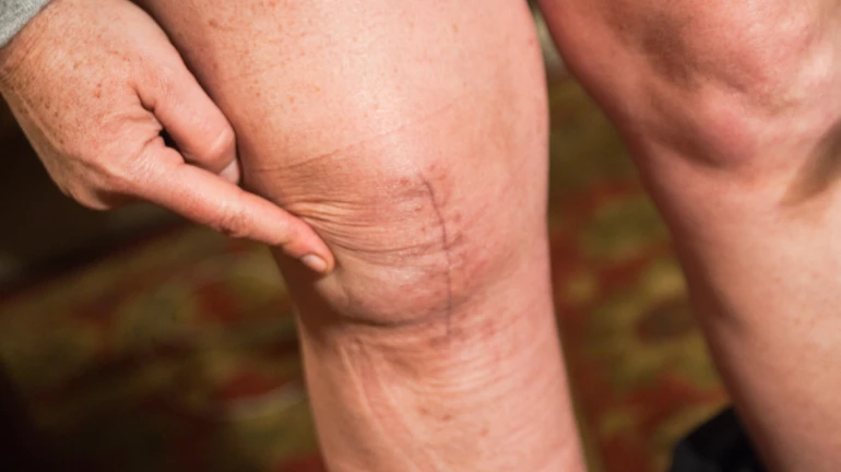 Apex Group of Hospitals completes 200 Robotic Knee Replacement Surgeries Apex Group of Hospitals completes 200 Robotic Knee Replacement Surgeries