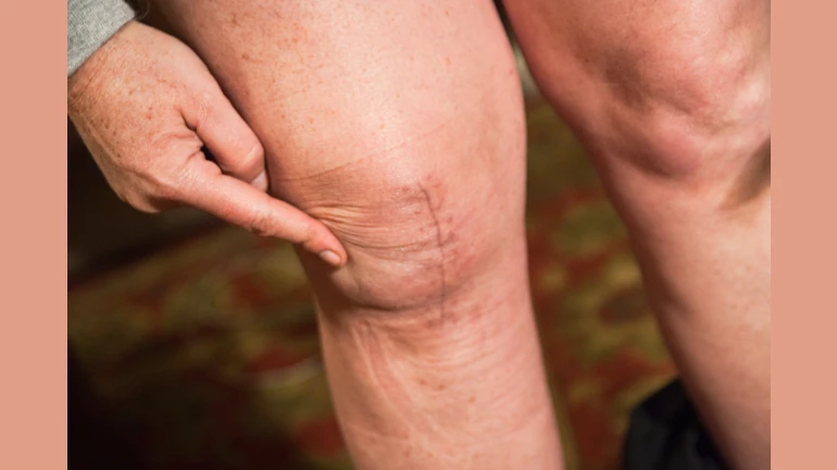 62-year-old Mumbai woman weighing 123 kg undergoes advanced robotic knee replacement surgery 62-year-old Mumbai woman weighing 123 kg undergoes advanced robotic knee replacement surgery