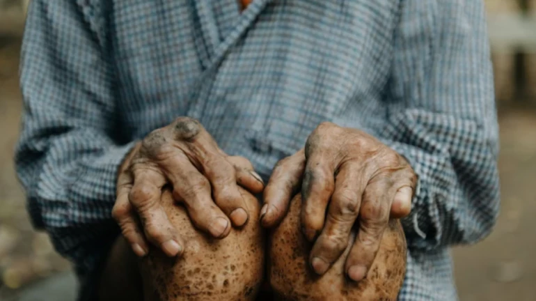 महाराष्ट्र - कुष्ठ खोज अभियान के तहत राज्य में 17 नवंबर से 2 दिसंबर तक घर-घर जाँच महाराष्ट्र - कुष्ठ खोज अभियान के तहत राज्य में 17 नवंबर से 2 दिसंबर तक घर-घर जाँच