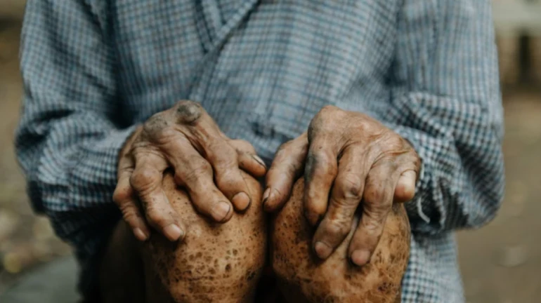 More than 8.5 crore citizens will be surveyed for Leprosy and tuberculosis More than 8.5 crore citizens will be surveyed for Leprosy and tuberculosis