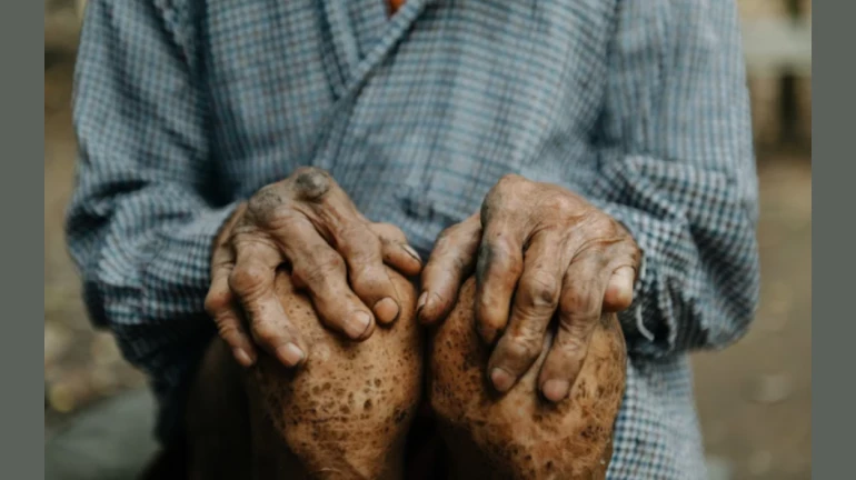 ठाण्यात 711 कुष्टरोगी बाधितांची नोंद ठाण्यात 711 कुष्टरोगी बाधितांची नोंद