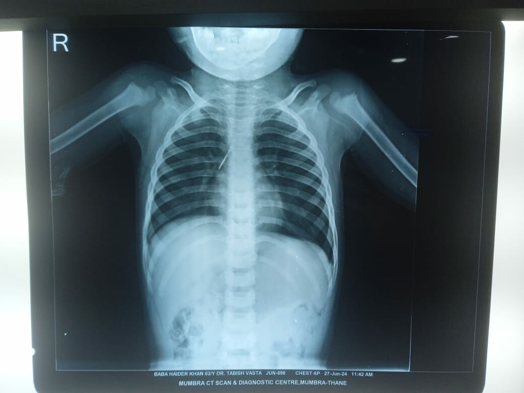Doctor Removes Dental File Accidentally Lodged In A 3-Year-Old Boy’s Right Lung