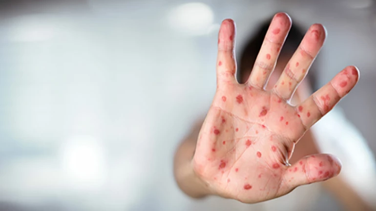 गोवरसाठी 'धारावी मॉडेल', पालिका लसीकरणावर भर देणार गोवरसाठी 'धारावी मॉडेल', पालिका लसीकरणावर भर देणार