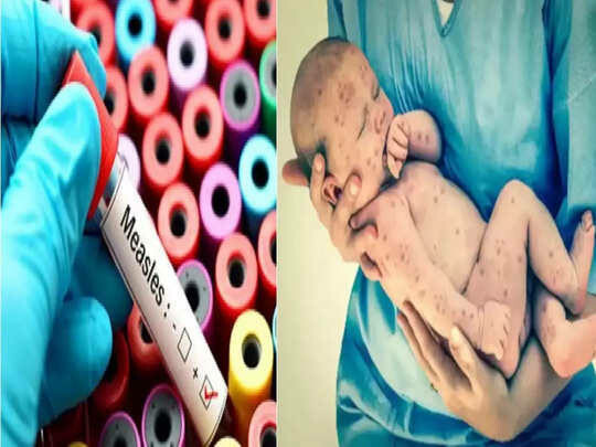 मुंबईत गोवरचं थैमान! सव्वा वर्षाच्या मुलीचा मृत्यू