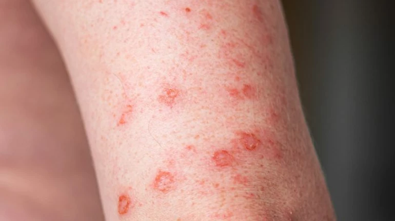 महाराष्ट्र में भी मंकीपॉक्स वायरस लक्षणों वाली जैसी बीमारियों से चिंता महाराष्ट्र में भी मंकीपॉक्स वायरस लक्षणों वाली जैसी बीमारियों से चिंता