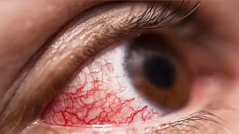 मुंबईत म्युकरमायकोसिसच्या 'इतकी' रुग्णांमध्ये घट मुंबईत म्युकरमायकोसिसच्या 'इतकी' रुग्णांमध्ये घट