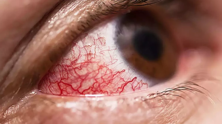 मुंबई में म्यूकोमाइकोसिस के 400 मरीज मुंबई में म्यूकोमाइकोसिस के 400 मरीज