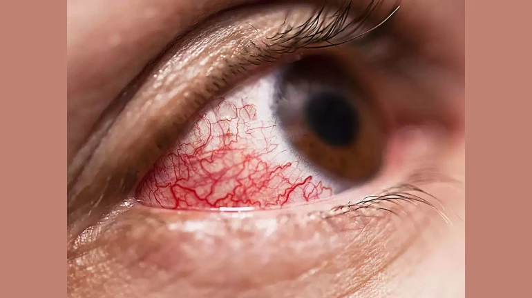 21 people died due to mucormycosis so far in Navi Mumbai 21 people died due to mucormycosis so far in Navi Mumbai