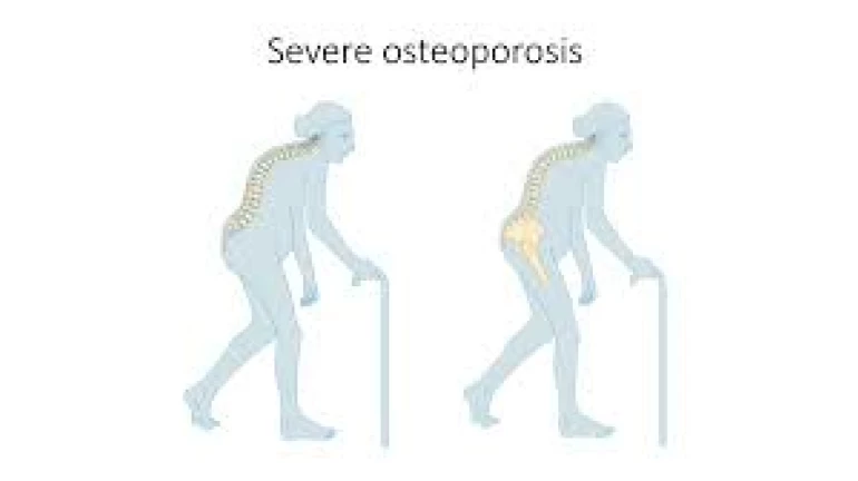 Increase in Osteoporosis Cases post-COVID-19 due to psychological effects