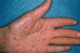 Here's all you need to know about Scleroderma Syndrome - Signs, Symptoms, Treatment & Precautions
