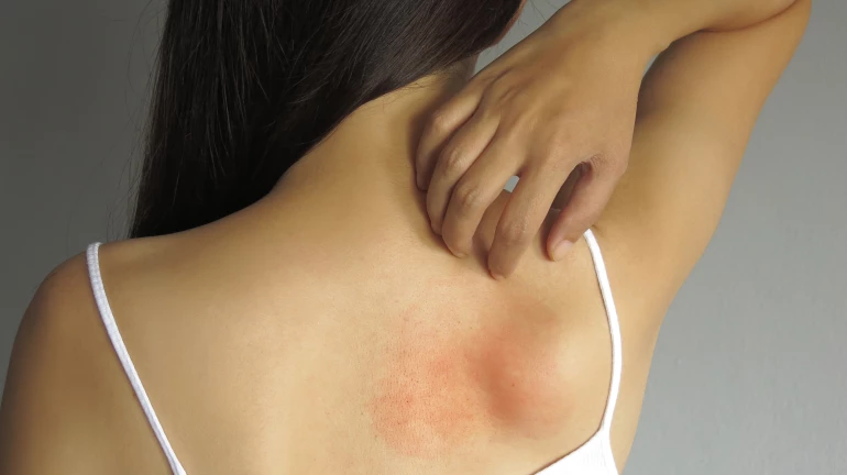Summer Tips : Suffering from heat rashes and sunburns? Try these 7 remedies at home