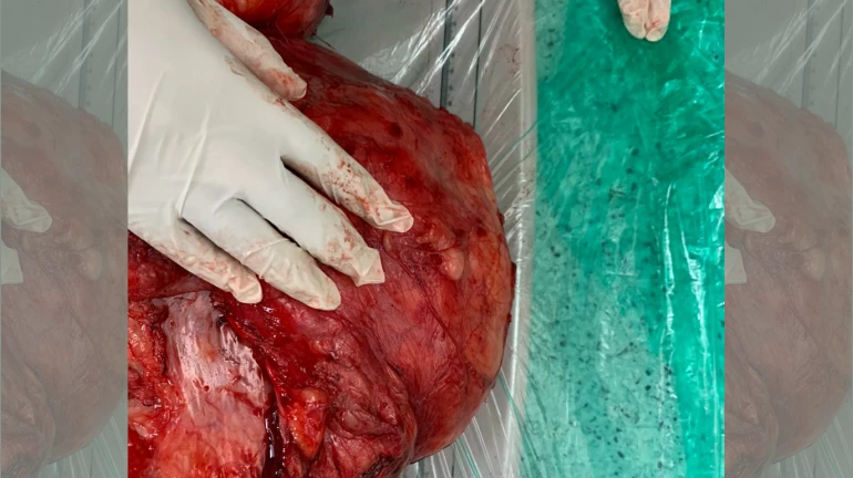 Doctors from Mumbai remove a giant 11-kg tumor from woman’s abdomen